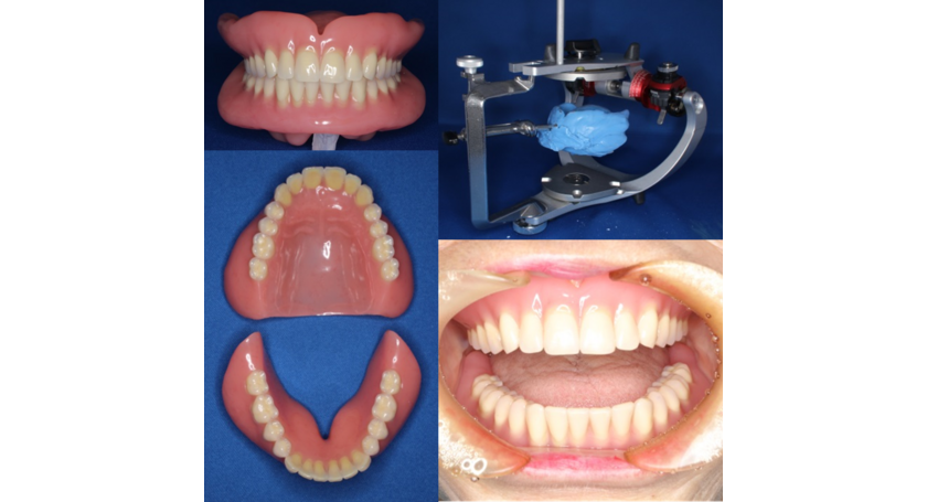 総入れ歯上下同時印象