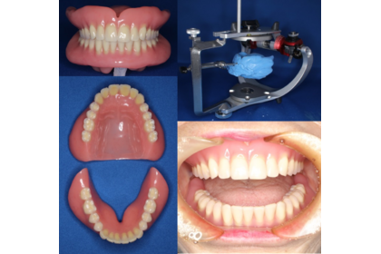総入れ歯上下同時印象