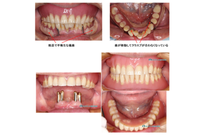 レジリエンツテレスコープ義歯の症例001