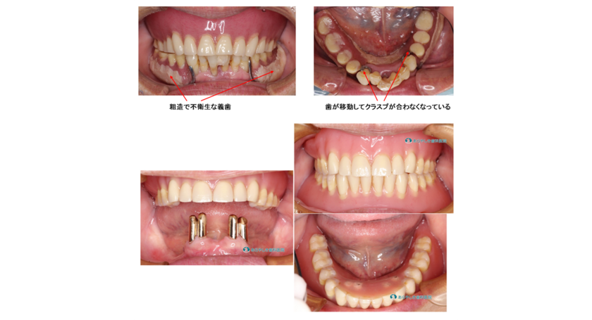 レジリエンツテレスコープ義歯の症例001
