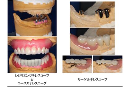 各種ドイツ式テレスコープ義歯