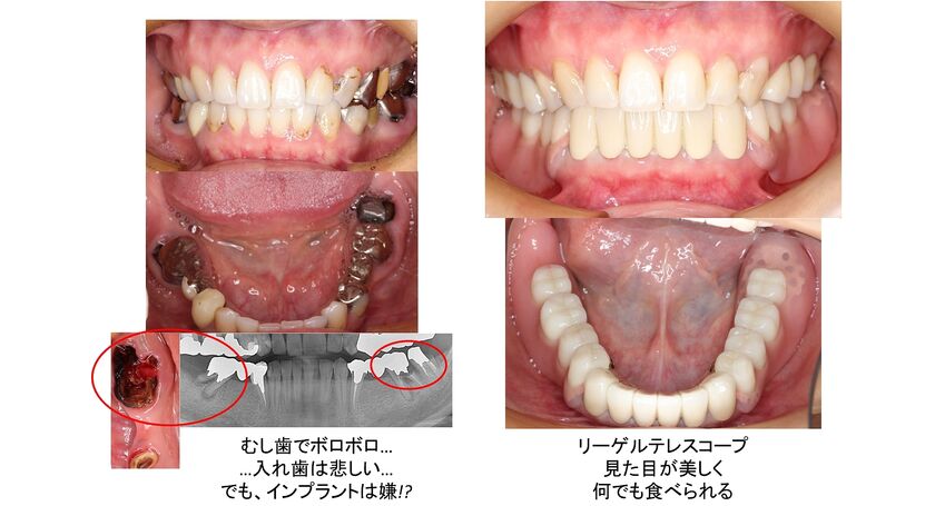 30代の入れ歯リーゲルテレスコープ義歯
