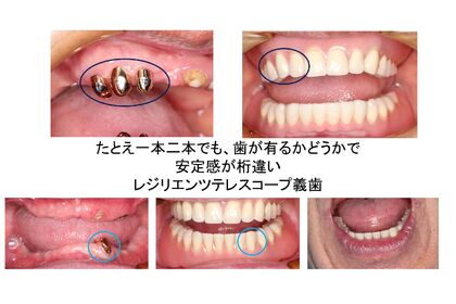 レジリエンツテレスコープ義歯 2症例