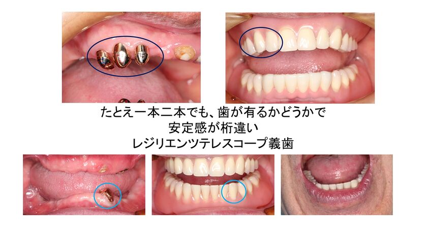 レジリエンツテレスコープ義歯 2症例