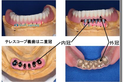 テレスコープ義歯は二重冠構造