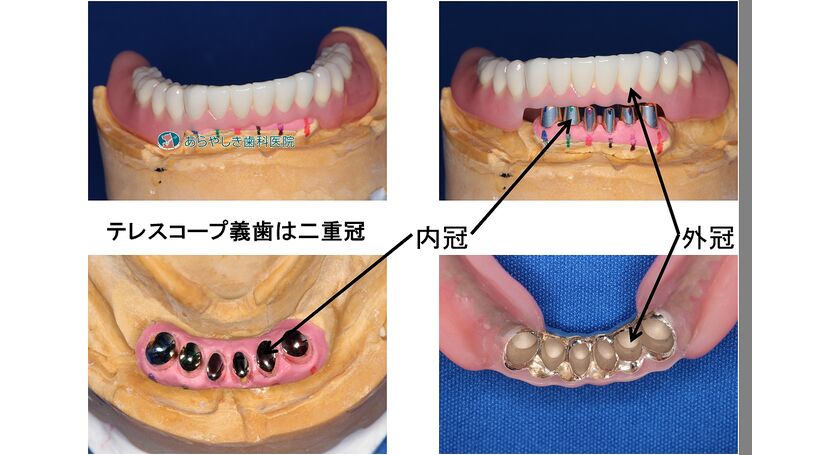 テレスコープ義歯は二重冠構造