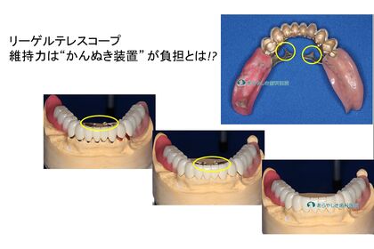 リーゲルテレスコープ義歯の維持力とは