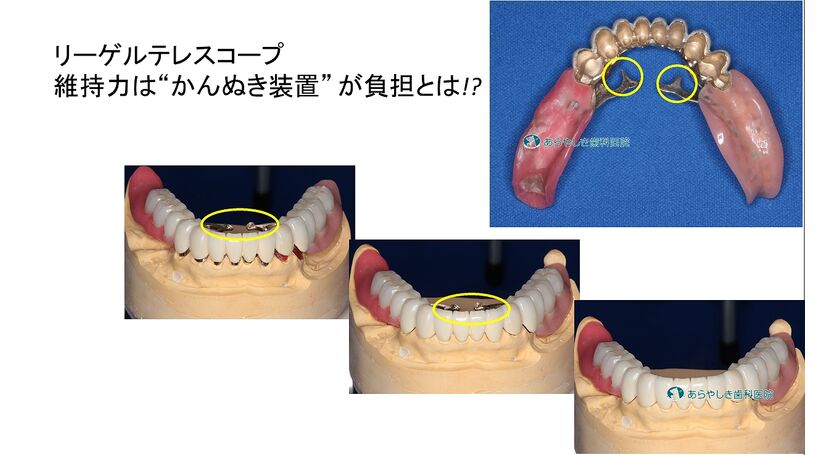 リーゲルテレスコープ義歯の維持力とは
