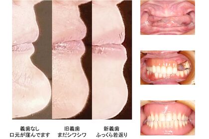 総義歯の口元