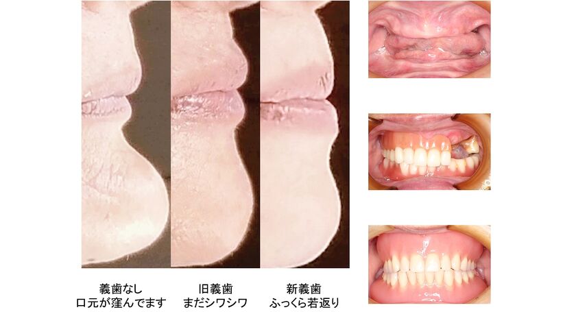 総義歯の口元