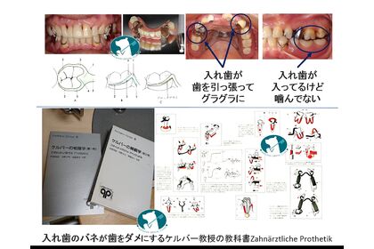 クラスプ義歯が歯をダメにする