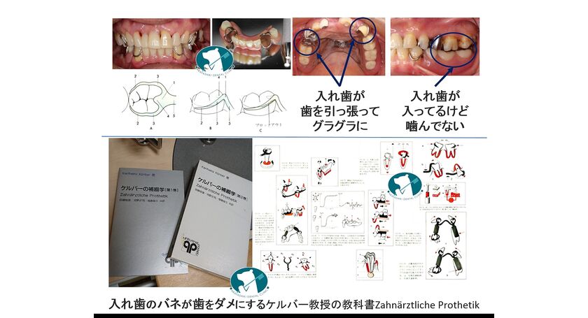 クラスプ義歯が歯をダメにする