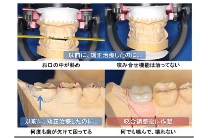 歯列矯正後の機能不全