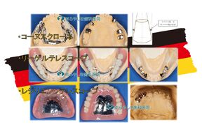 コーヌス・リーゲル・レジリエンツ_ドイツ式入れ歯