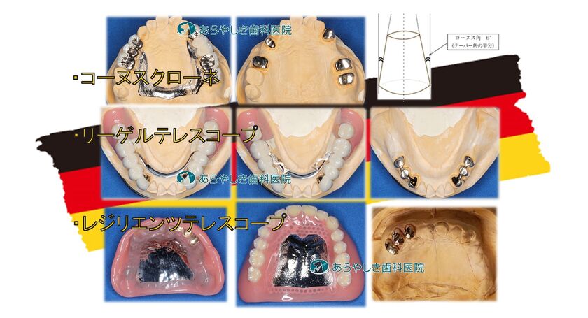 コーヌス・リーゲル・レジリエンツ_ドイツ式入れ歯